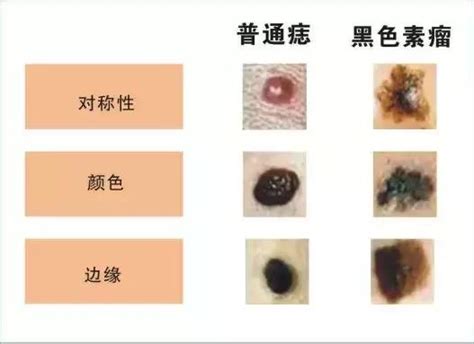 痣種類|痣形成的原因？痣長毛、痣變多變大是痣病變？5招判。